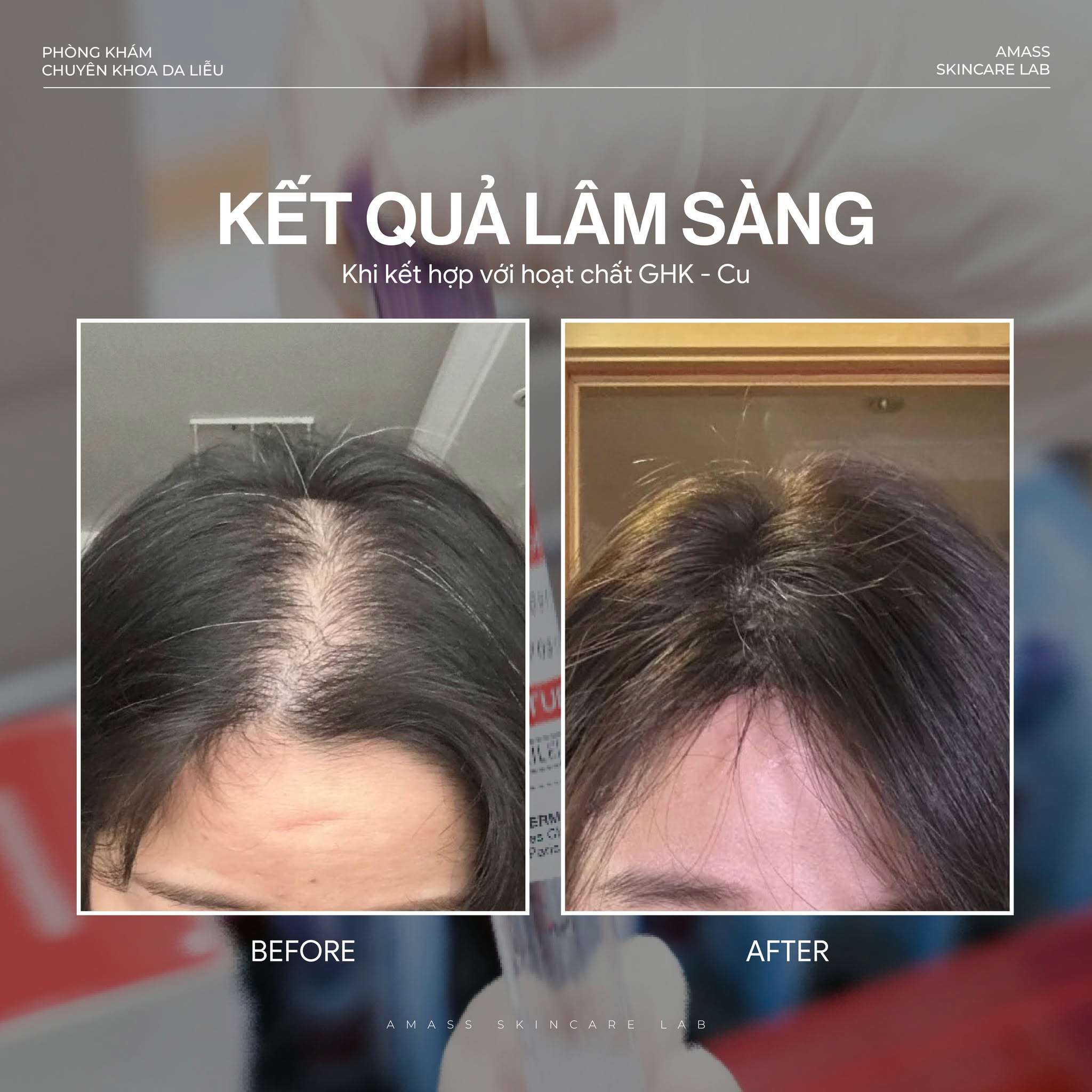 Ứng Dụng Peptide GHK-Cu Trong Điều Trị Rụng Tóc Chuẩn Y Khoa
